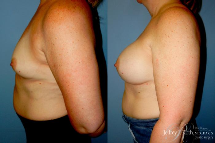 Before & After Breast Augmentation Case 347 Left Side View in Las Vegas and Henderson, NV