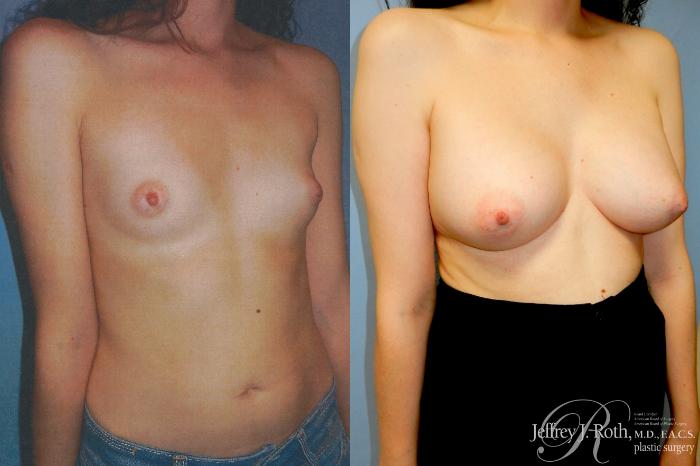 Before & After Breast Augmentation Case 348 Right Oblique View in Las Vegas and Henderson, NV