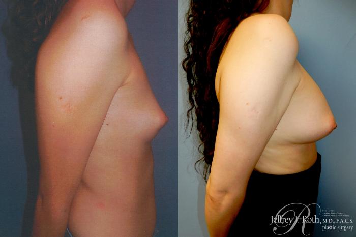 Before & After Breast Augmentation Case 348 Right Side View in Las Vegas and Henderson, NV