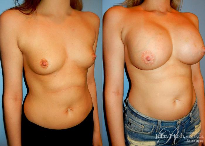 Before & After Breast Augmentation Case 36 View #2 View in Las Vegas and Henderson, NV