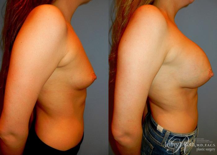 Before & After Breast Augmentation Case 36 View #3 View in Las Vegas and Henderson, NV