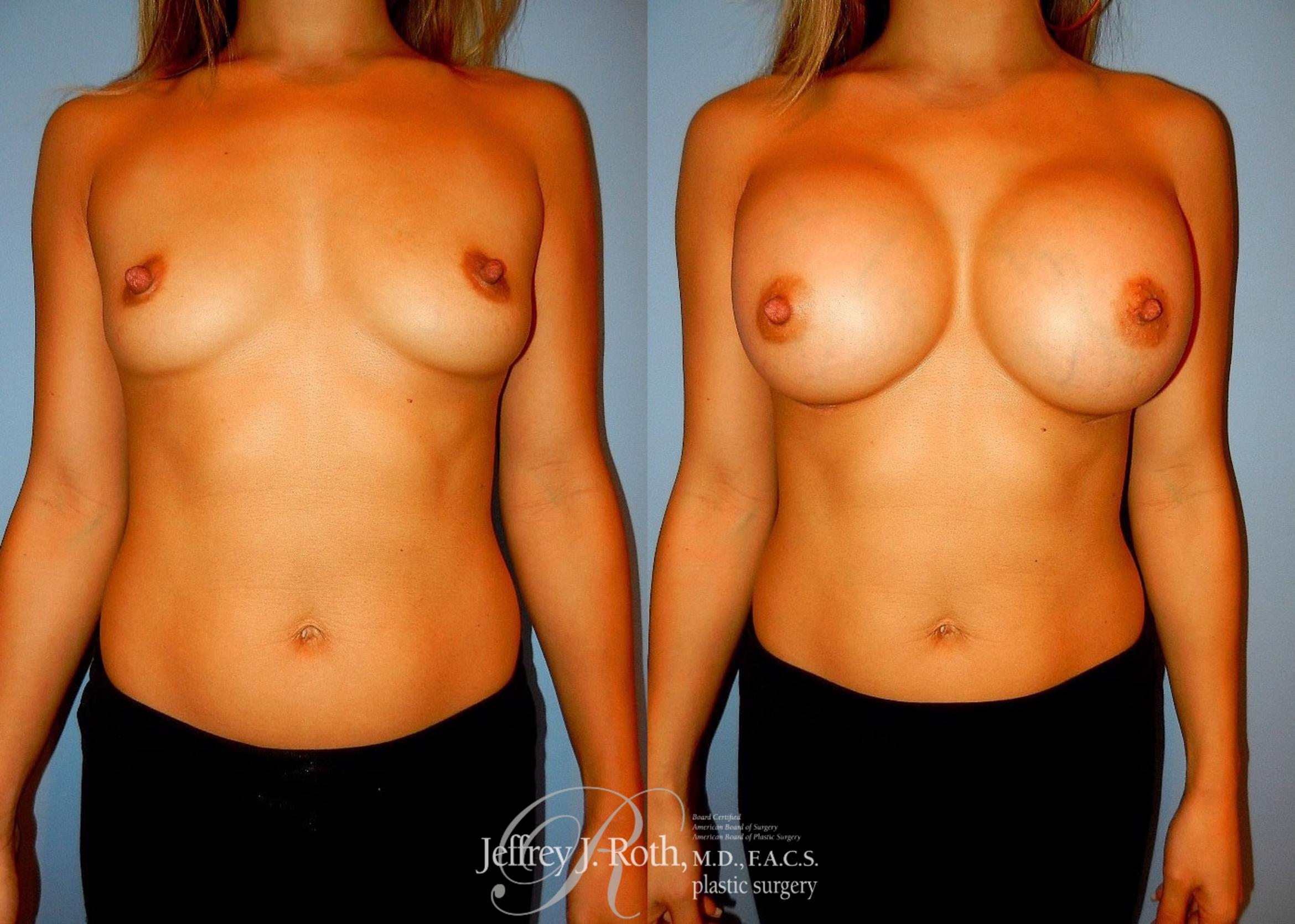 Before & After Breast Augmentation Case 37 View #1 View in Las Vegas, NV