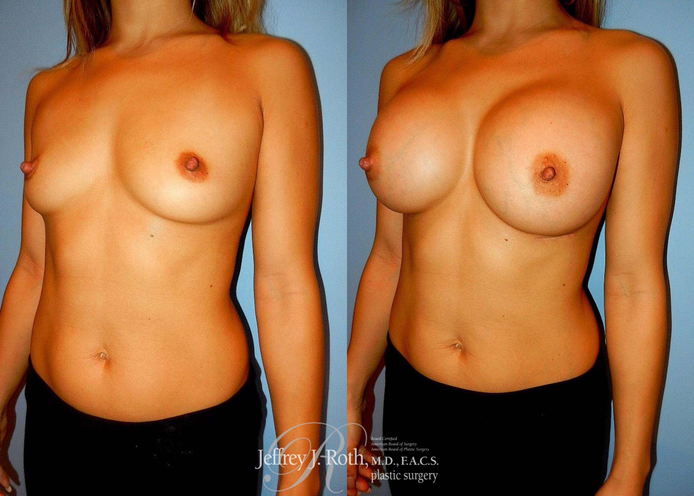 Before & After Breast Augmentation Case 37 View #2 View in Las Vegas, NV