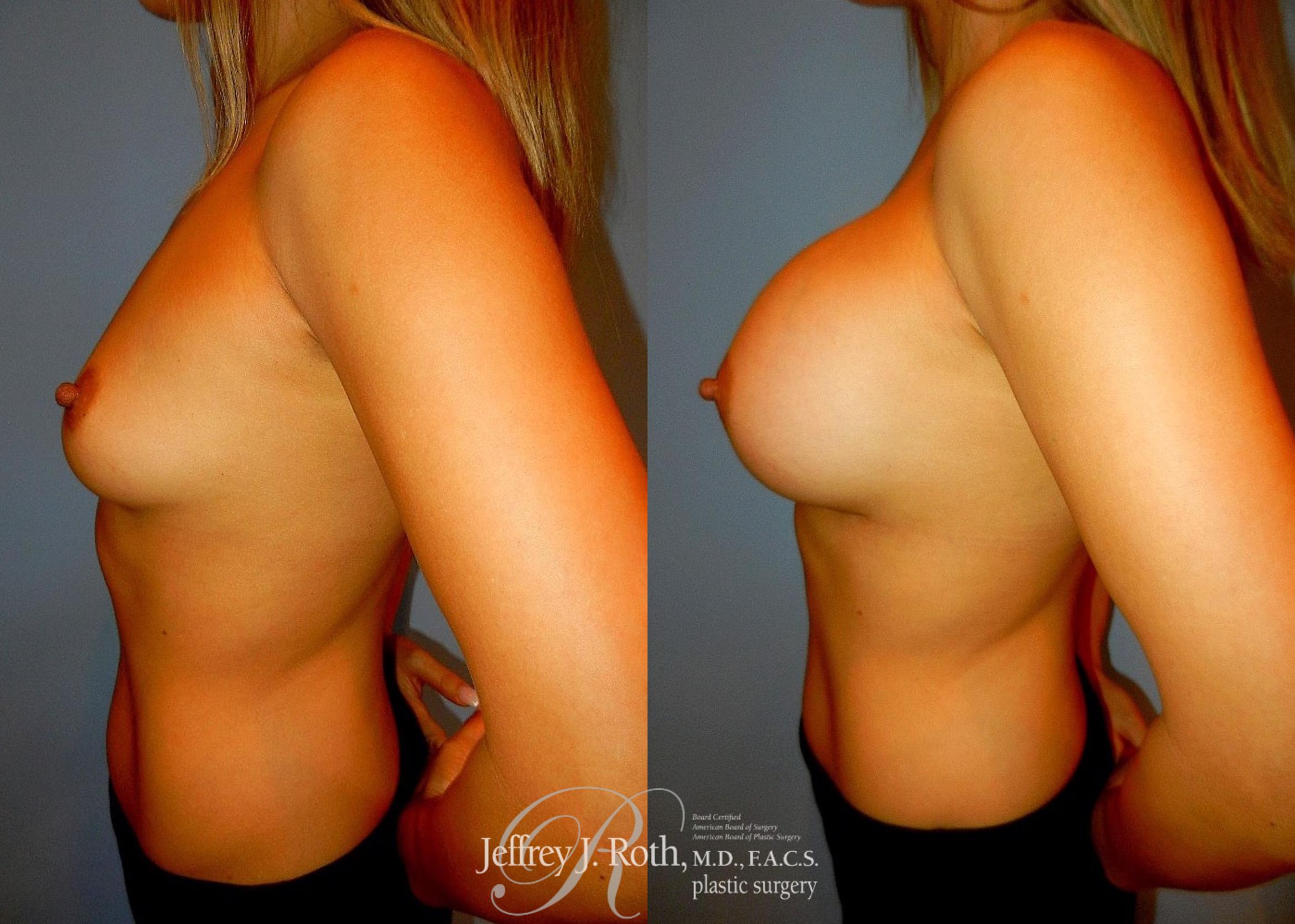 Before & After Breast Augmentation Case 37 View #3 View in Las Vegas, NV