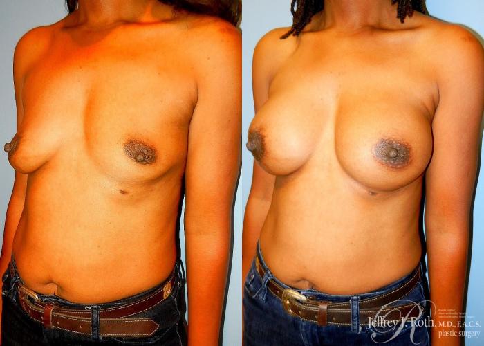 Before & After Breast Augmentation Case 39 View #2 View in Las Vegas, NV