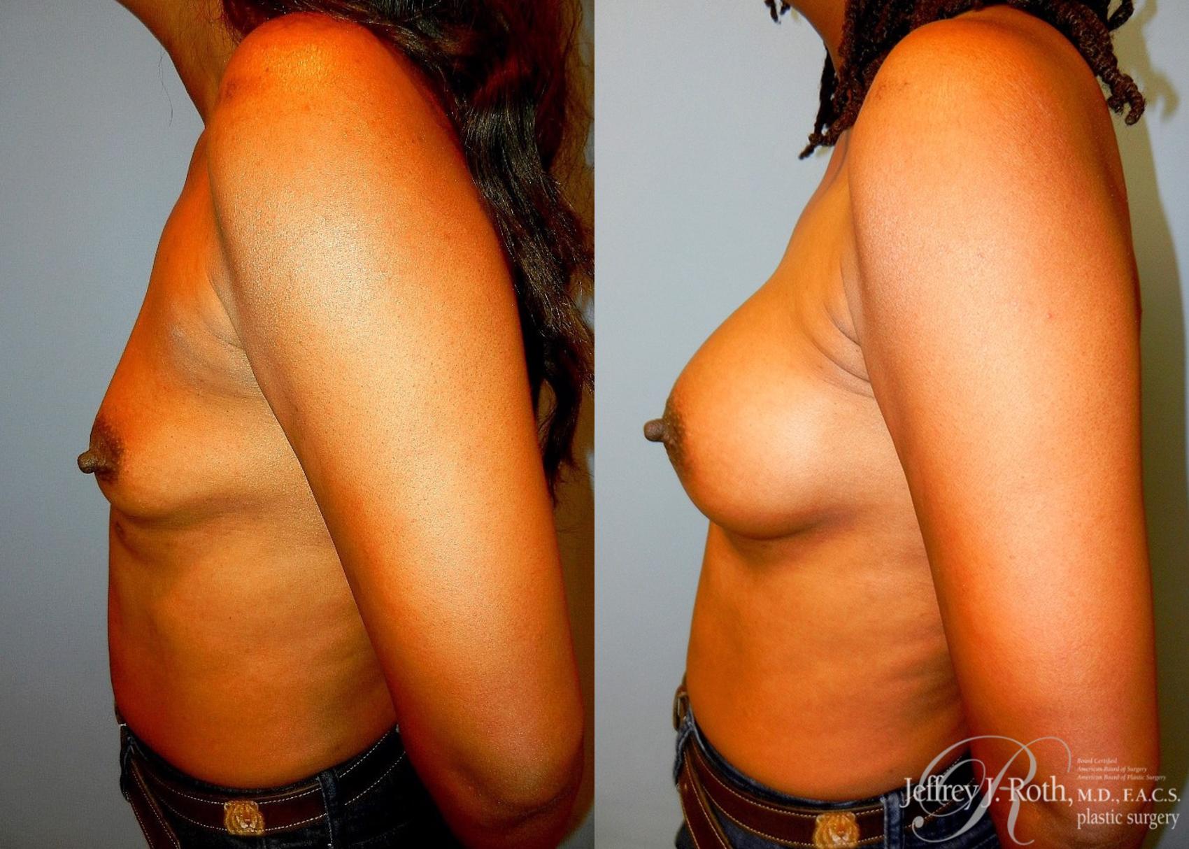 Before & After Breast Augmentation Case 39 View #3 View in Las Vegas, NV
