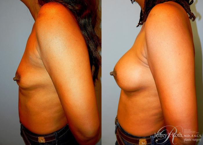Before & After Breast Augmentation Case 39 View #3 View in Las Vegas and Henderson, NV