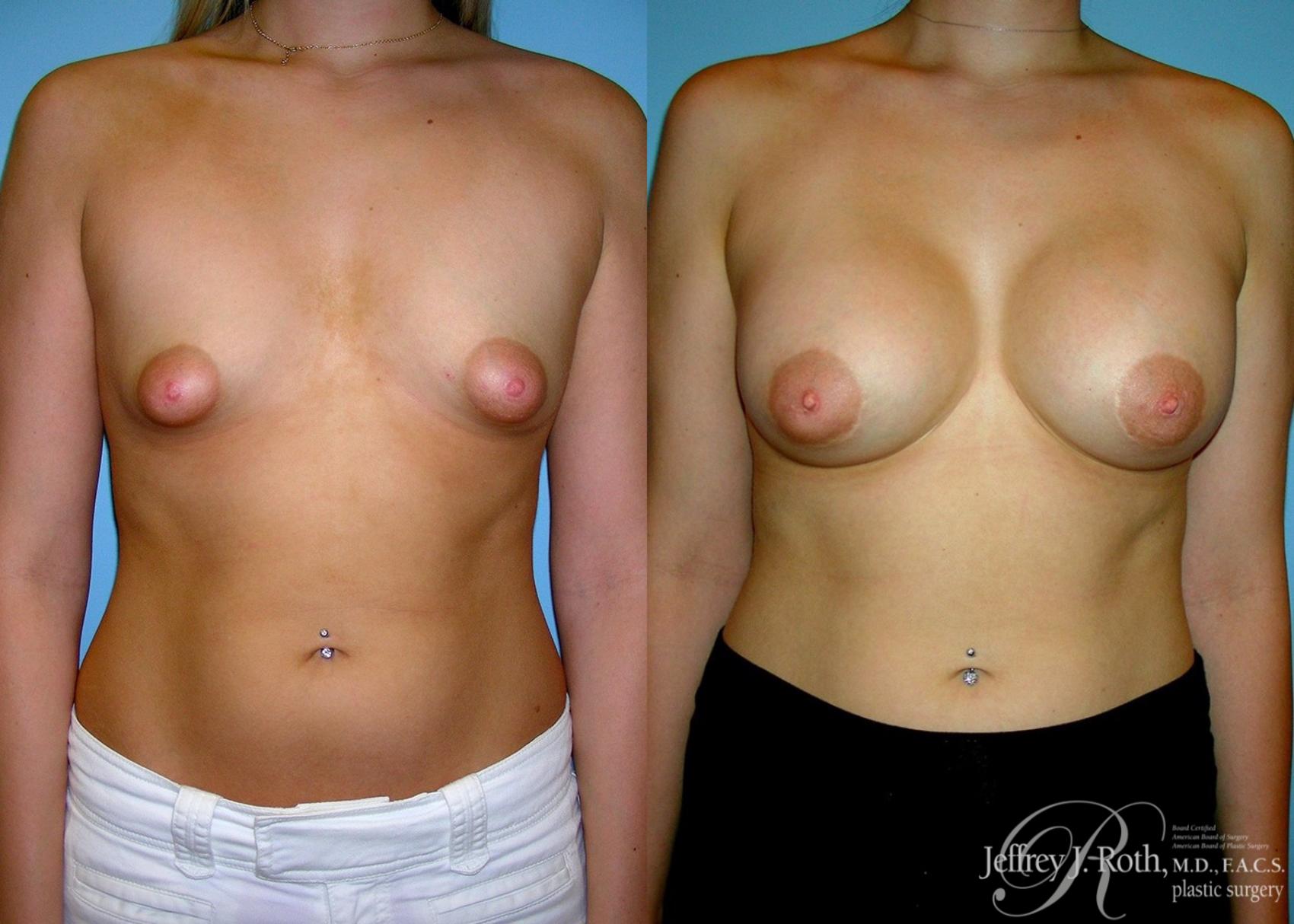Before & After Breast Augmentation Case 40 View #1 View in Las Vegas, NV