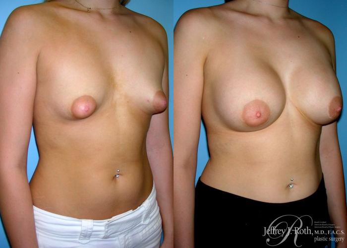 Before & After Breast Augmentation Case 40 View #2 View in Las Vegas and Henderson, NV