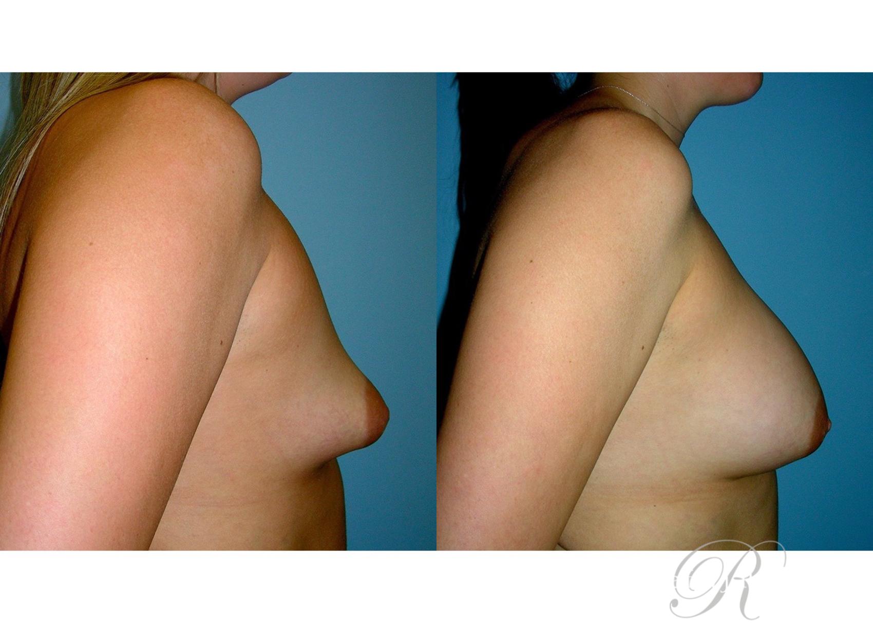 Before & After Breast Augmentation Case 40 View #3 View in Las Vegas, NV