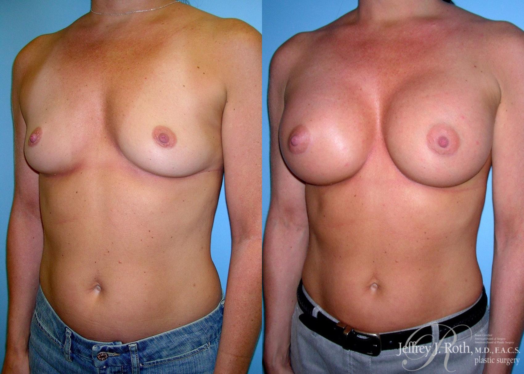 Before & After Breast Augmentation Case 42 View #2 View in Las Vegas, NV