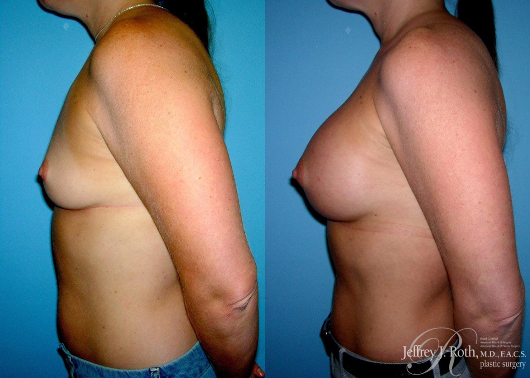 Before & After Breast Augmentation Case 42 View #3 View in Las Vegas, NV