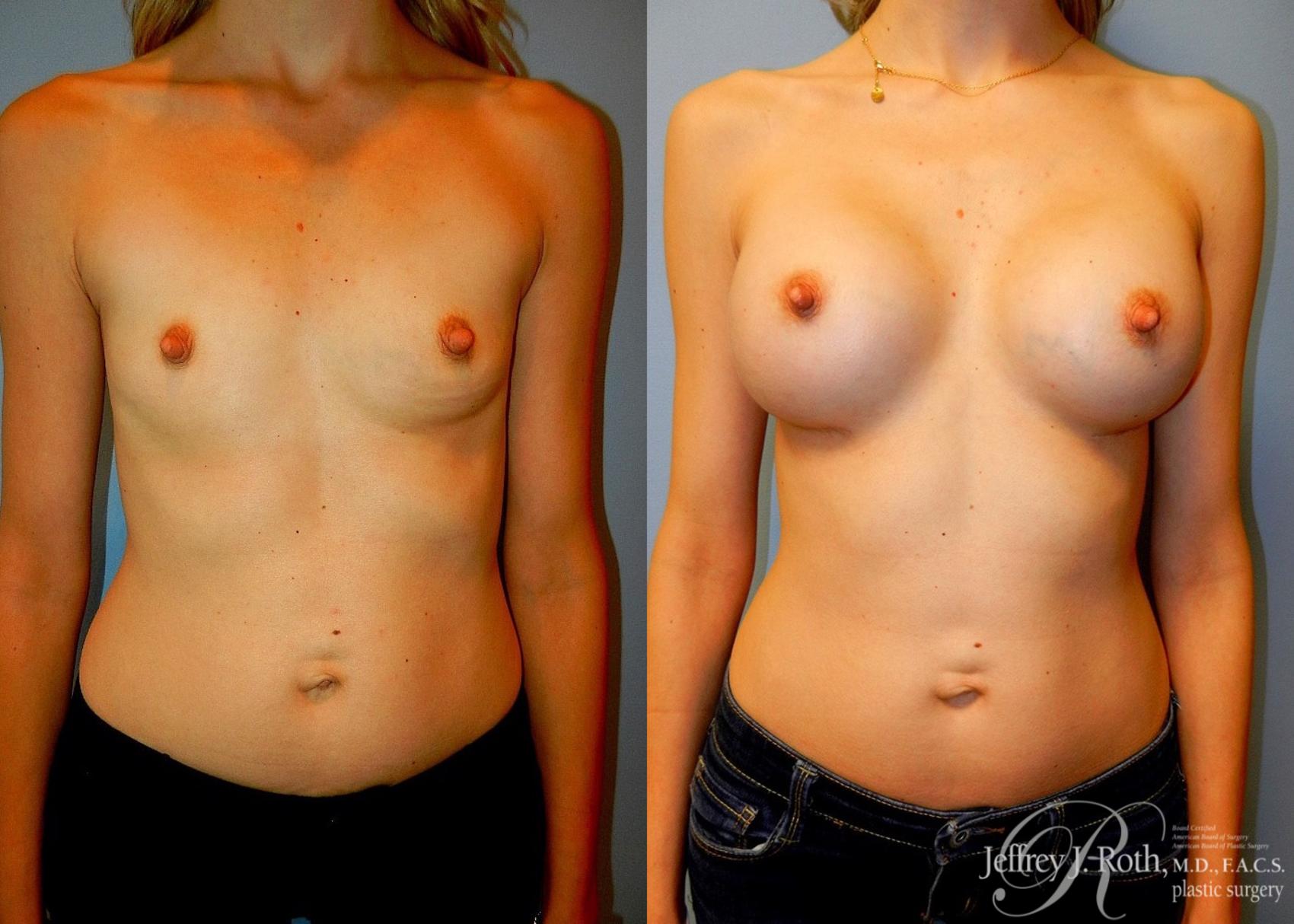 Before & After Breast Augmentation Case 43 View #1 View in Las Vegas, NV