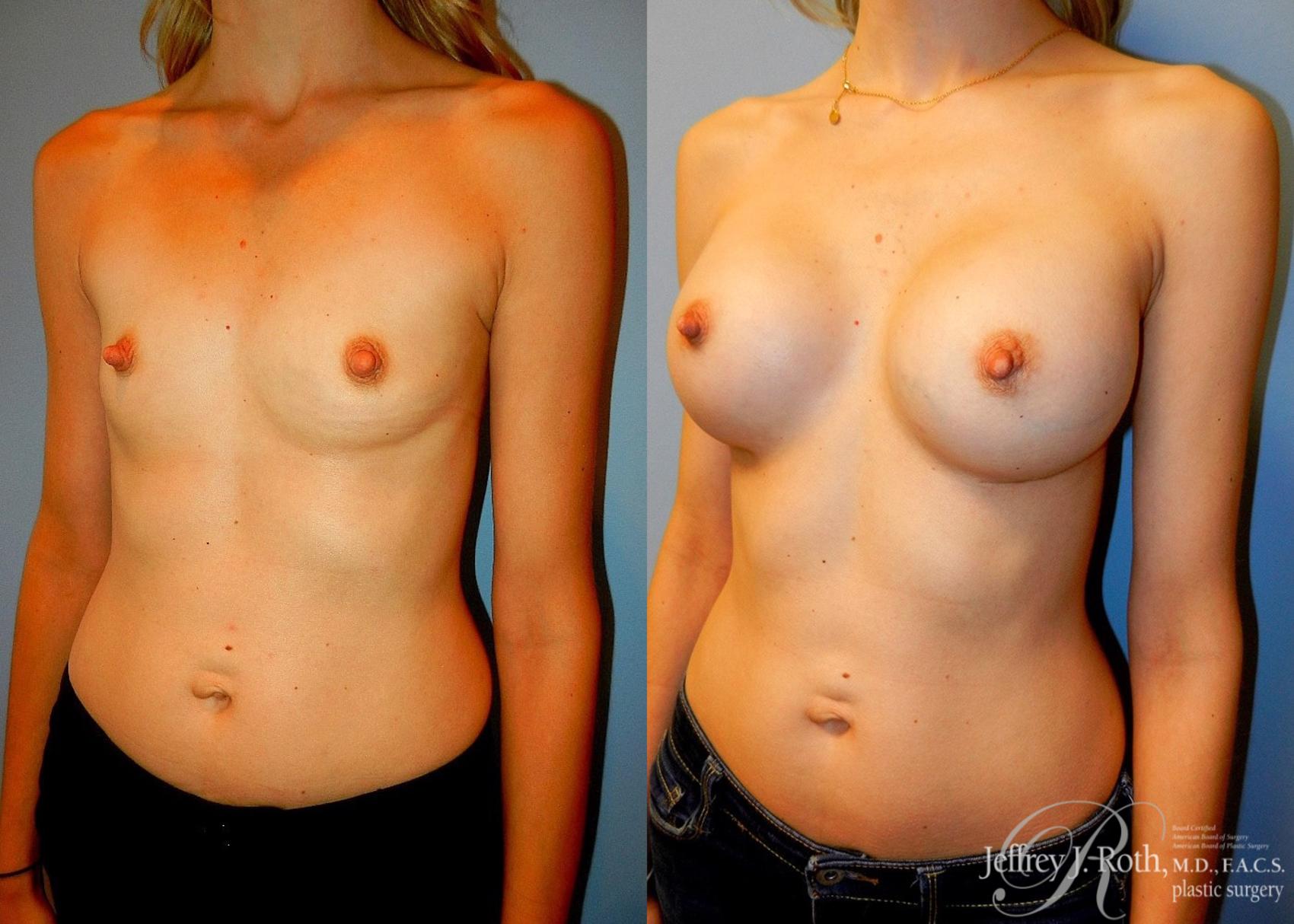 Before & After Breast Augmentation Case 43 View #2 View in Las Vegas, NV