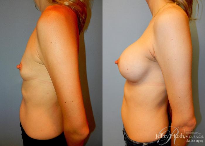 Before & After Breast Augmentation Case 43 View #3 View in Las Vegas and Henderson, NV