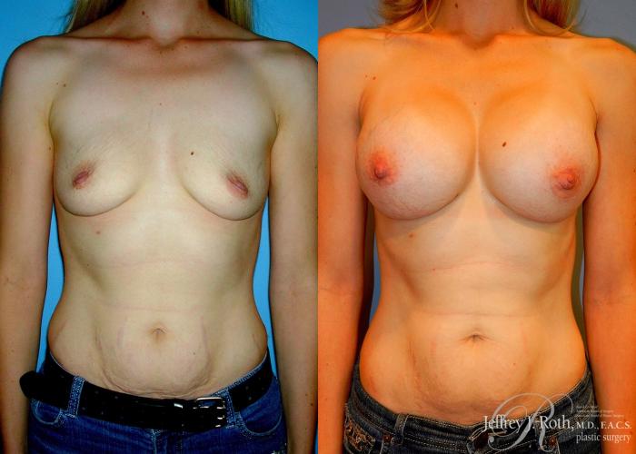 Before & After Breast Augmentation Case 44 View #1 View in Las Vegas and Henderson, NV