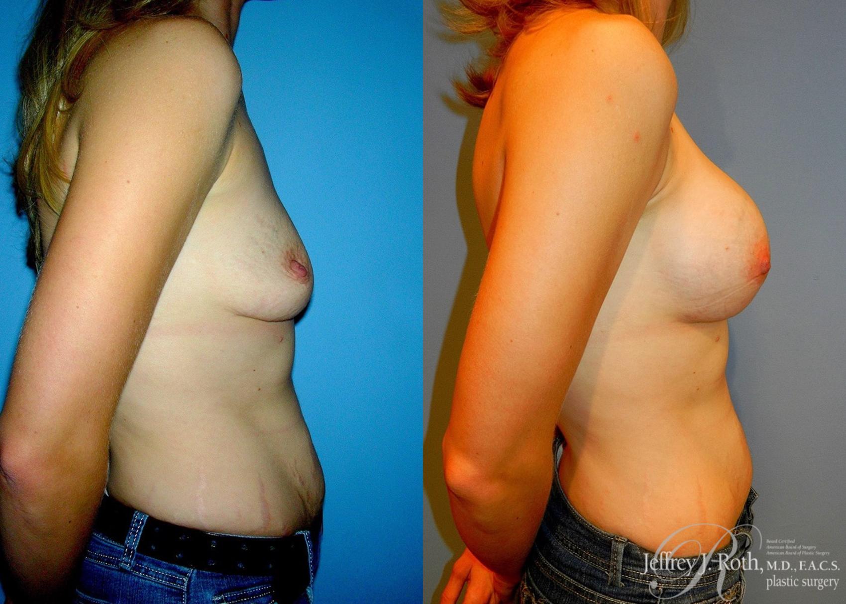 Before & After Breast Augmentation Case 44 View #3 View in Las Vegas, NV