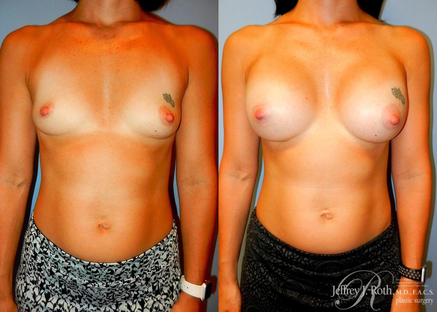 Before & After Breast Augmentation Case 45 View #1 View in Las Vegas, NV