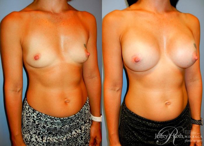 Before & After Breast Augmentation Case 45 View #2 View in Las Vegas and Henderson, NV