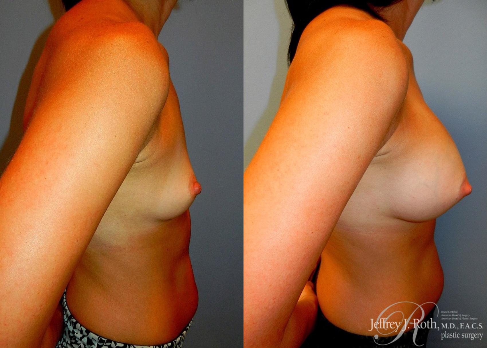 Before & After Breast Augmentation Case 45 View #3 View in Las Vegas, NV