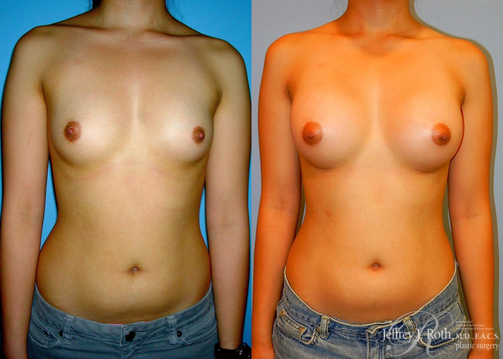 Before & After Breast Augmentation Case 46 View #1 View in Las Vegas, NV