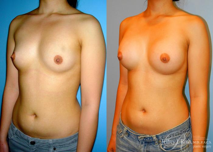 Before & After Breast Augmentation Case 46 View #2 View in Las Vegas and Henderson, NV