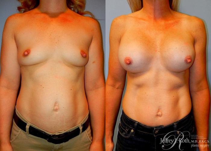 Before & After Breast Augmentation Case 47 View #1 View in Las Vegas, NV