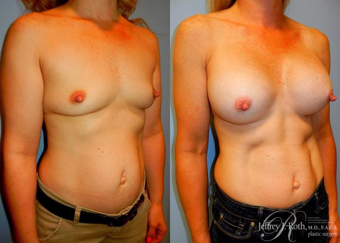 Before & After Breast Augmentation Case 47 View #2 View in Las Vegas, NV