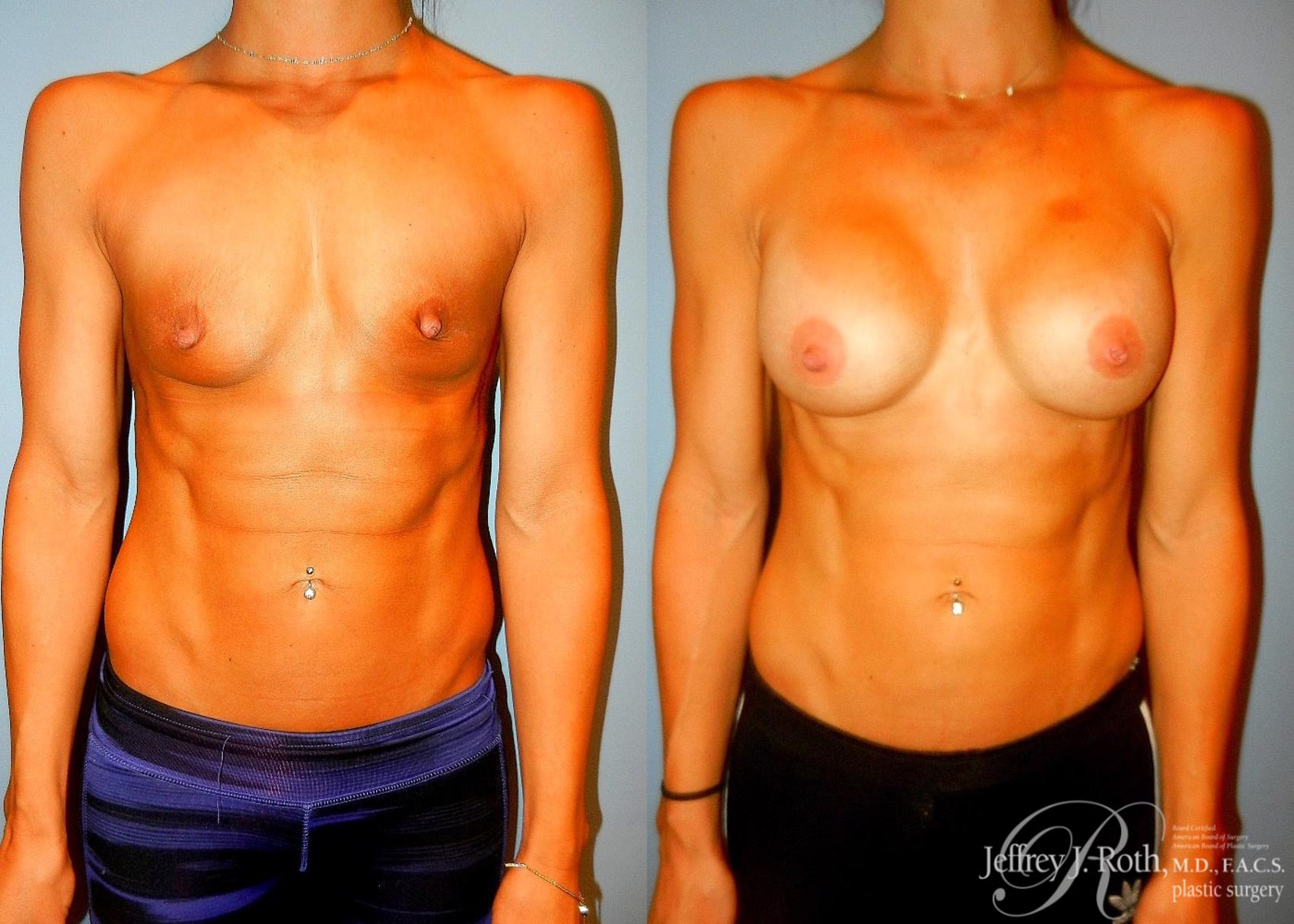Before & After Breast Augmentation Case 48 View #1 View in Las Vegas, NV