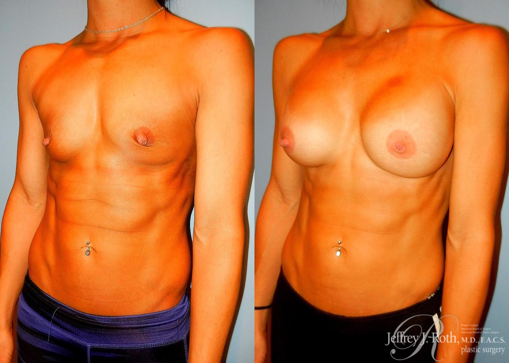 Before & After Breast Augmentation Case 48 View #2 View in Las Vegas, NV