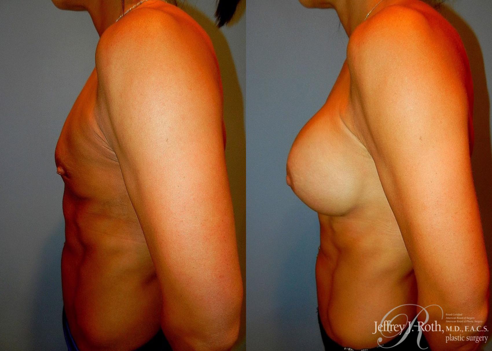 Before & After Breast Augmentation Case 48 View #3 View in Las Vegas, NV