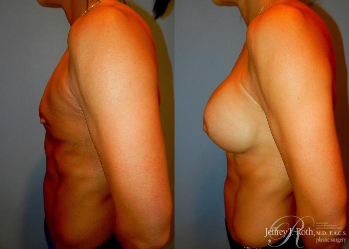 Before & After Breast Augmentation Case 48 View #3 View in Las Vegas and Henderson, NV