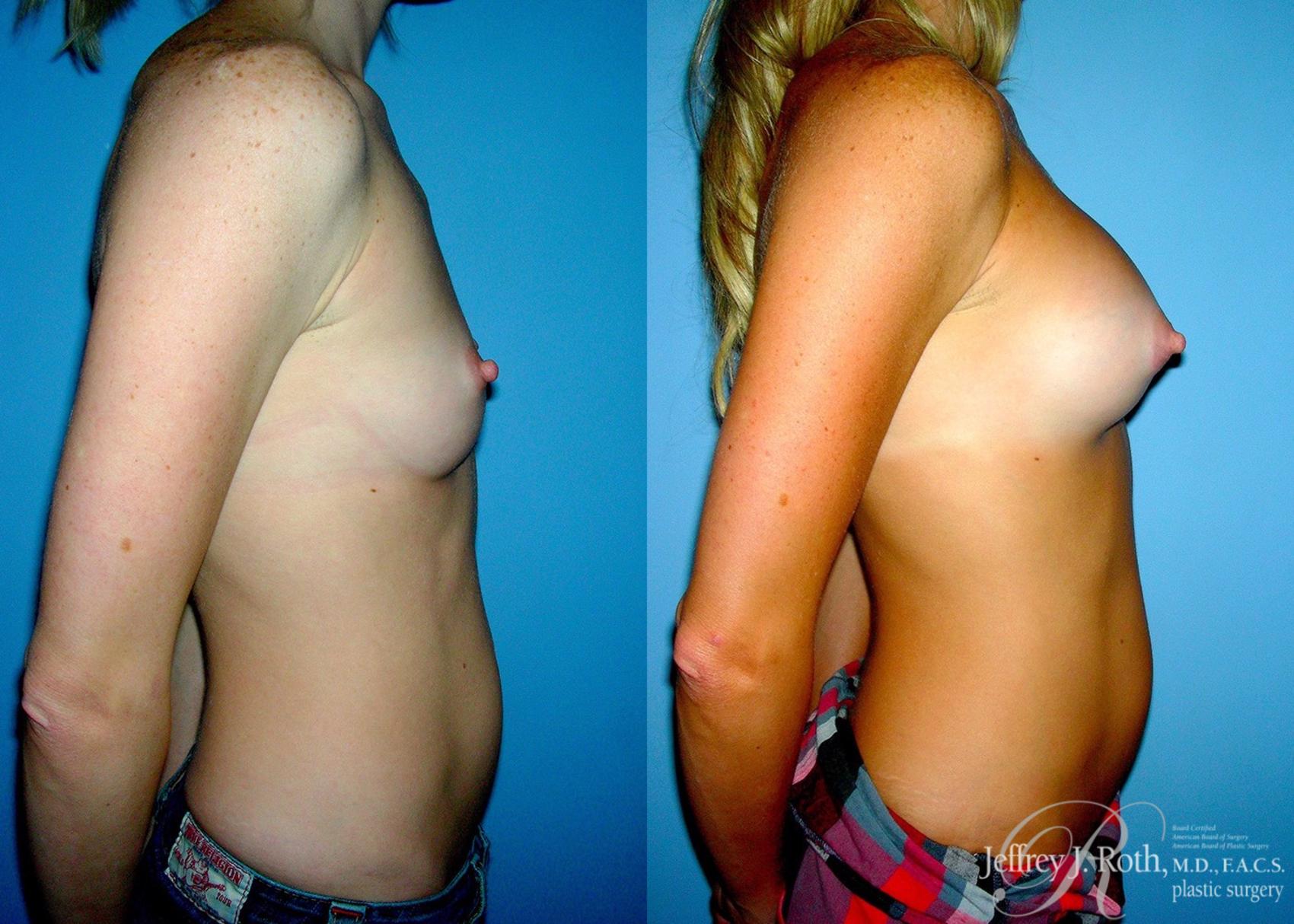 Before & After Breast Augmentation Case 49 View #3 View in Las Vegas, NV