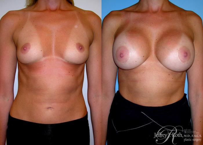 Before & After Breast Augmentation Case 50 View #1 View in Las Vegas and Henderson, NV
