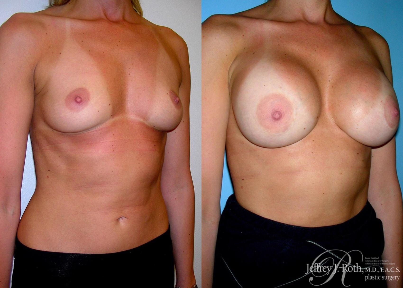 Before & After Breast Augmentation Case 50 View #2 View in Las Vegas, NV
