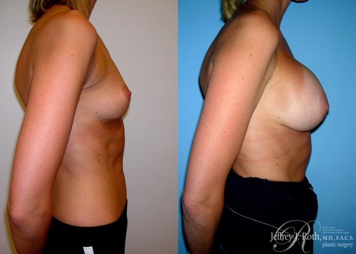Before & After Breast Augmentation Case 50 View #3 View in Las Vegas, NV