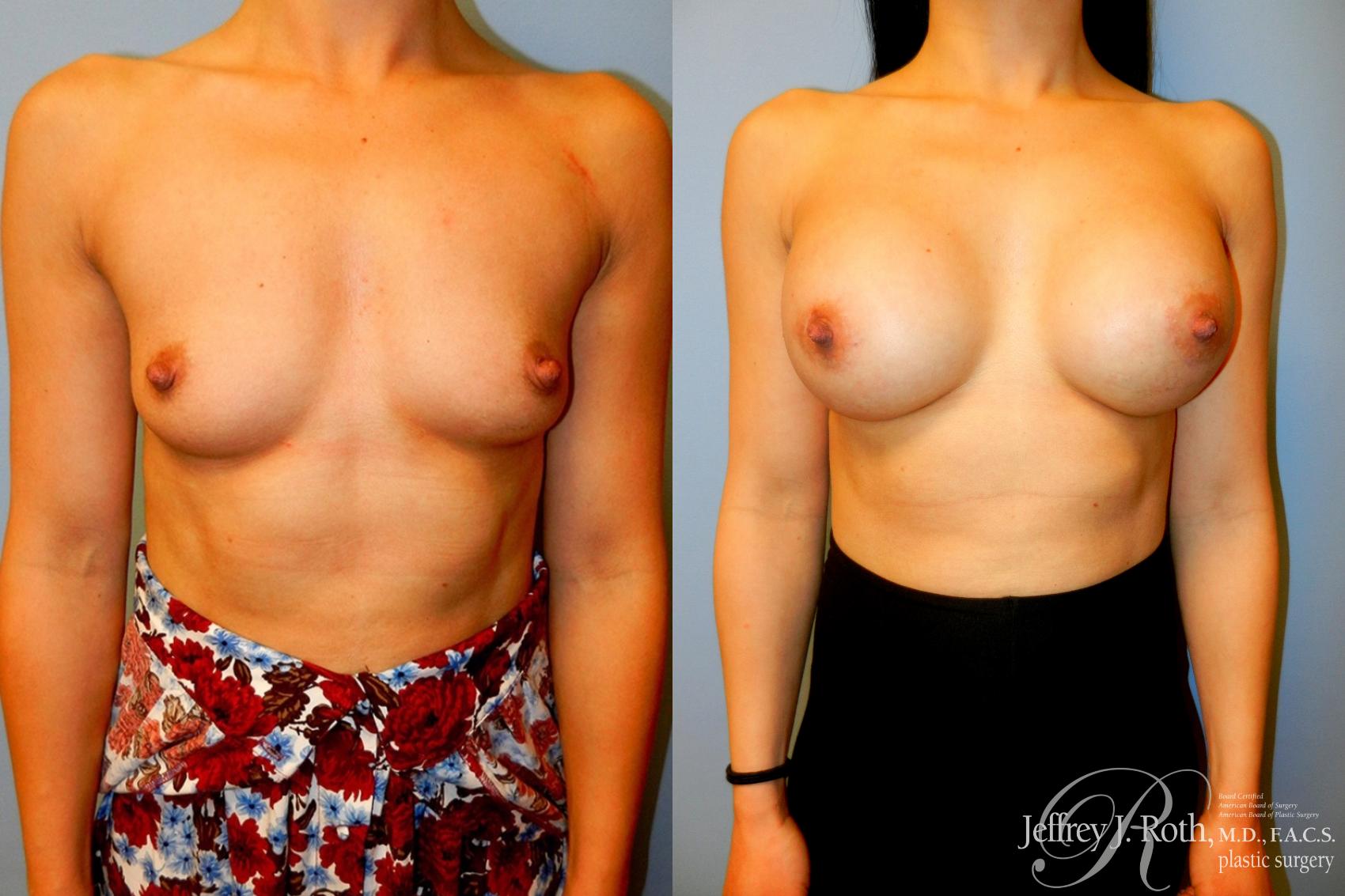 Before & After Breast Augmentation Case 51 View #1 View in Las Vegas, NV