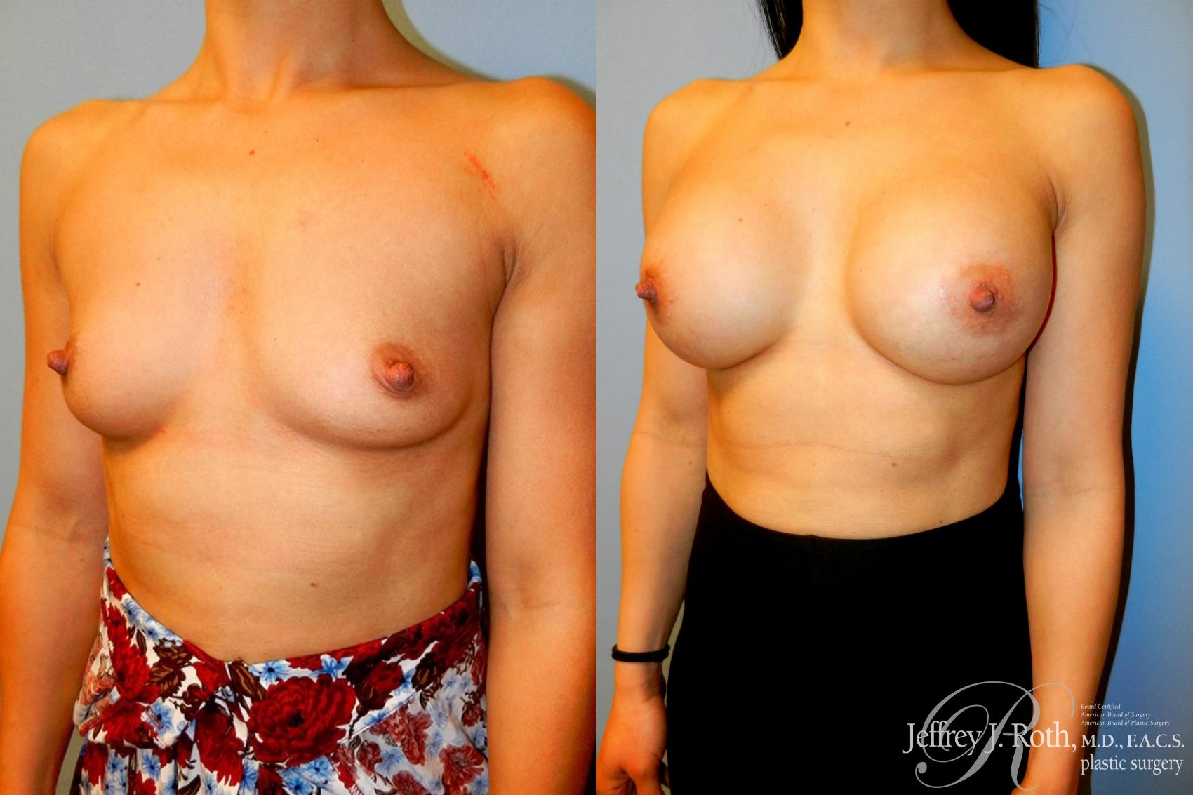 Before & After Breast Augmentation Case 51 View #2 View in Las Vegas, NV
