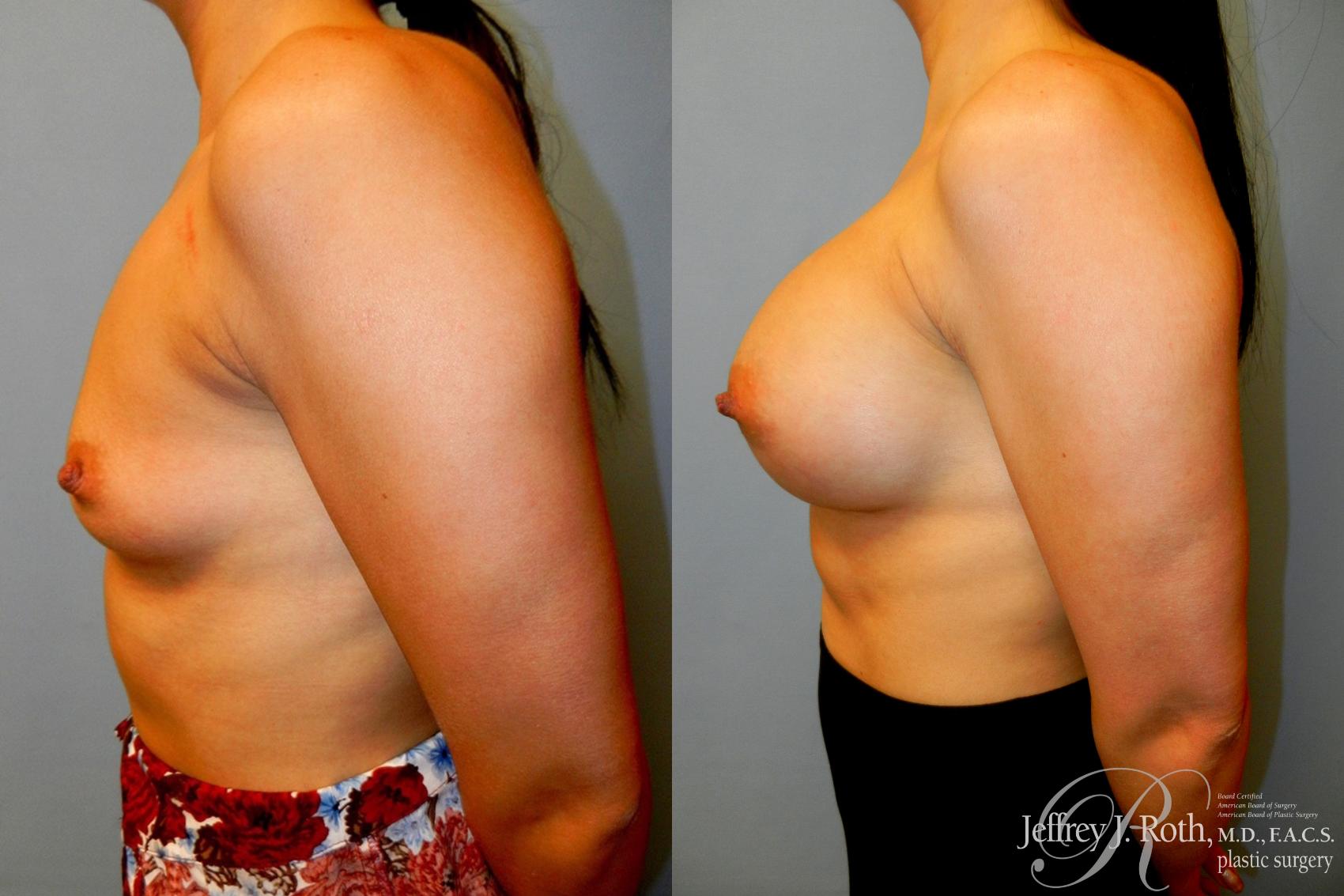 Before & After Breast Augmentation Case 51 View #3 View in Las Vegas, NV