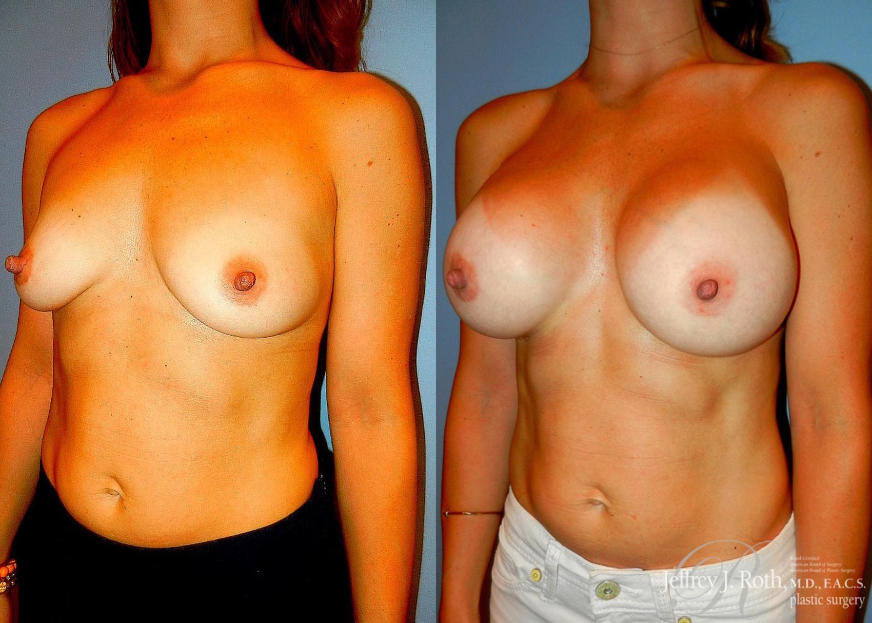 Before & After Breast Augmentation Case 52 View #2 View in Las Vegas, NV