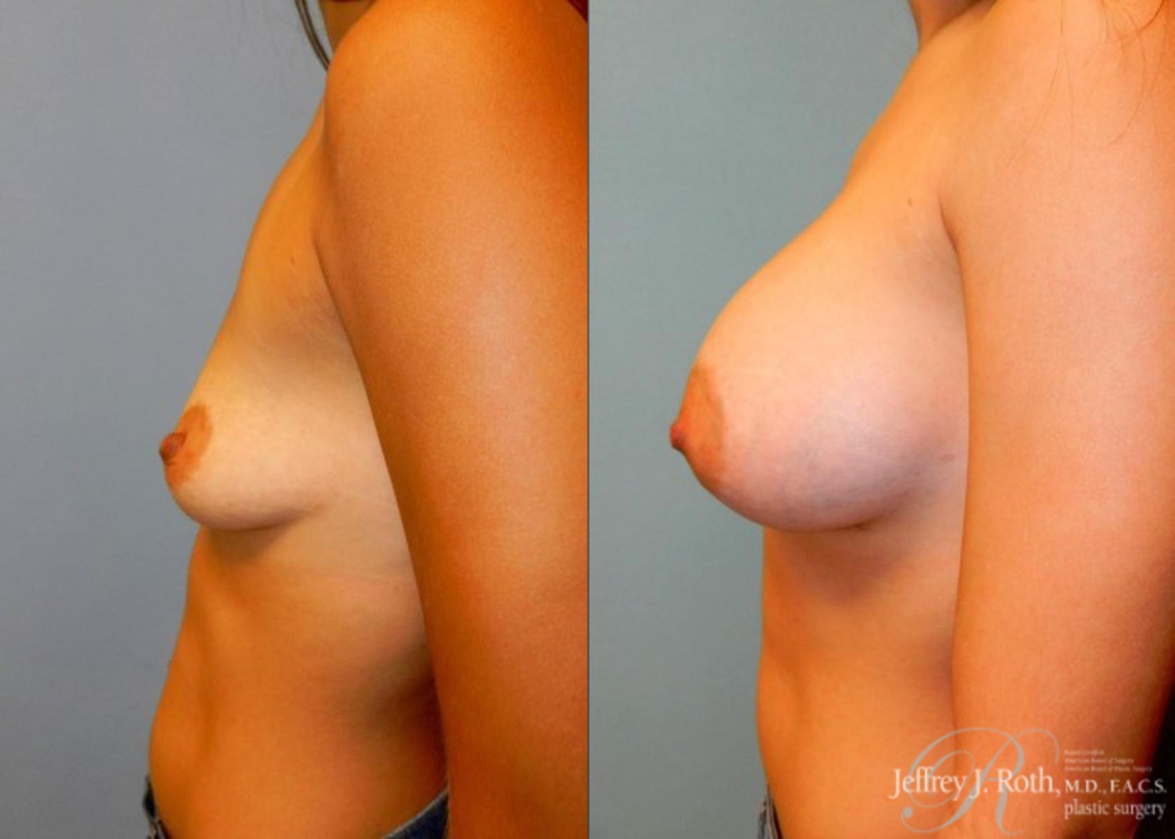 Before & After Breast Augmentation Case 53 View #3 View in Las Vegas, NV