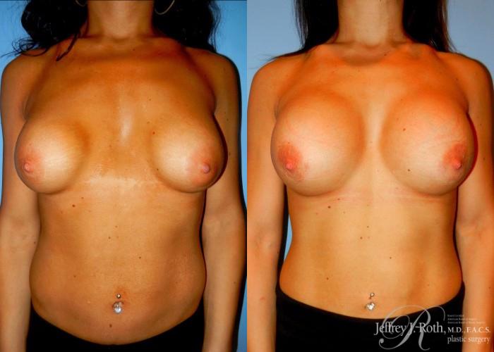 Before & After Breast Augmentation Revision Case 100 View #1 View in Las Vegas, NV