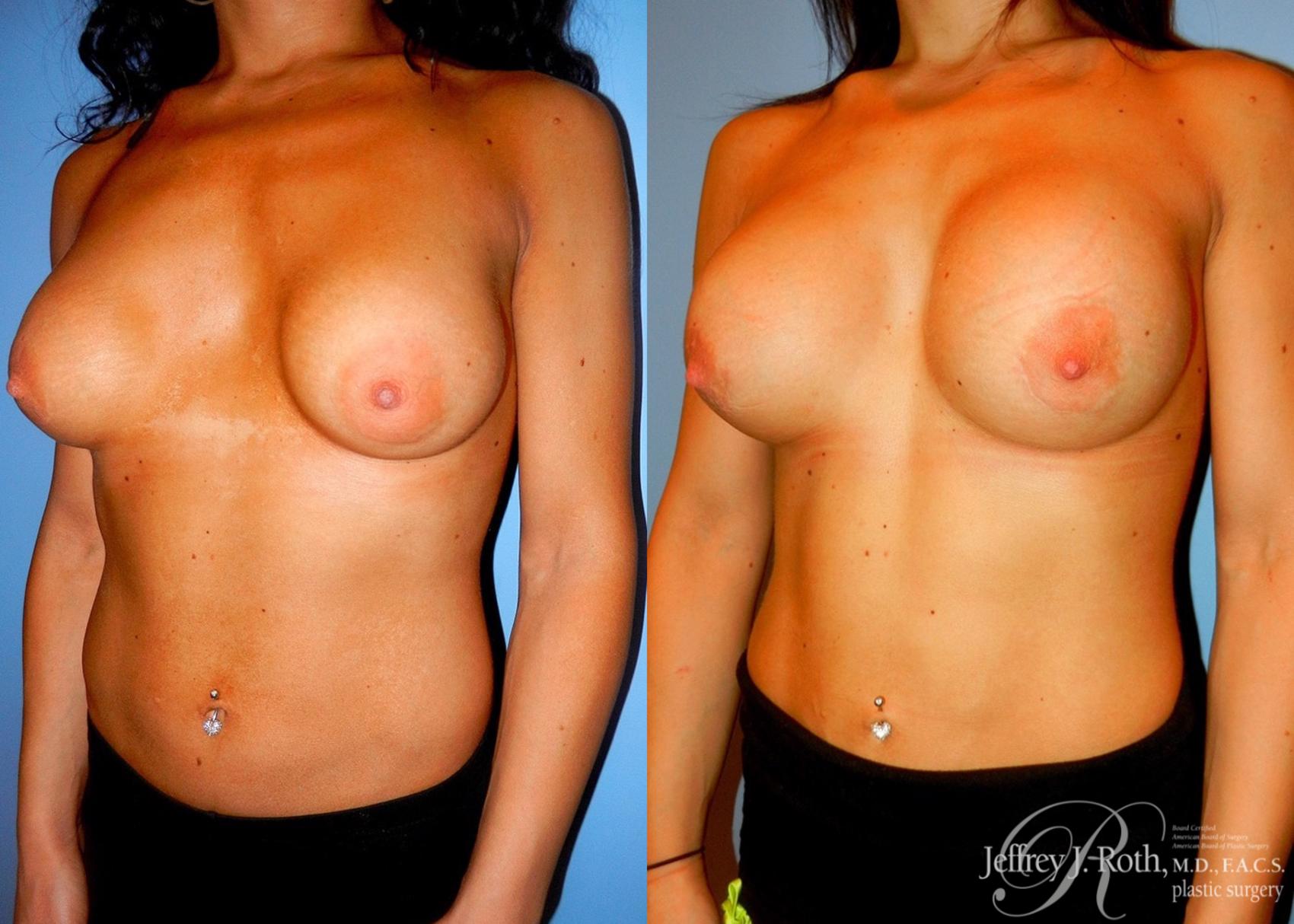 Before & After Breast Augmentation Revision Case 100 View #2 View in Las Vegas, NV