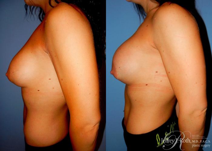 Before & After Breast Augmentation Revision Case 100 View #3 View in Las Vegas, NV