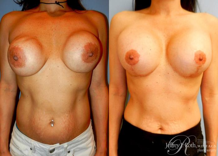 Before & After Breast Augmentation Revision Case 101 View #1 View in Las Vegas, NV