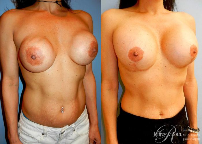 Before & After Breast Augmentation Revision Case 101 View #3 View in Las Vegas, NV