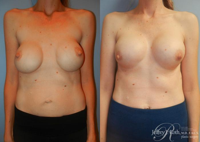 Before & After Breast Augmentation Revision Case 102 View #1 View in Las Vegas, NV