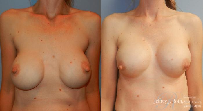 Before & After Breast Augmentation Revision Case 102 View #2 View in Las Vegas and Henderson, NV