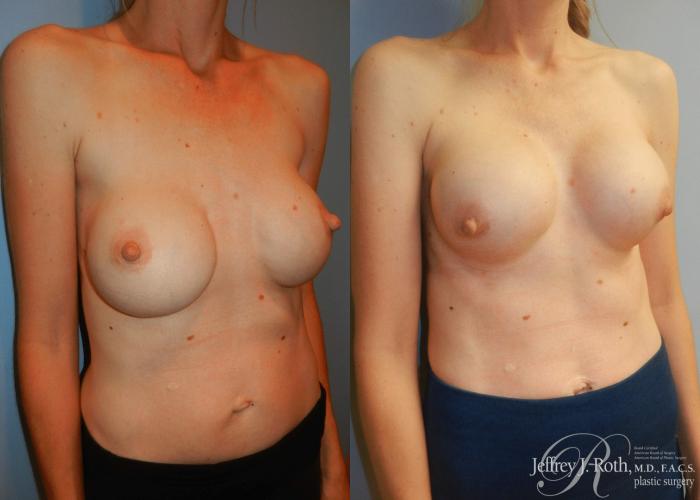 Before & After Breast Augmentation Revision Case 102 View #3 View in Las Vegas and Henderson, NV