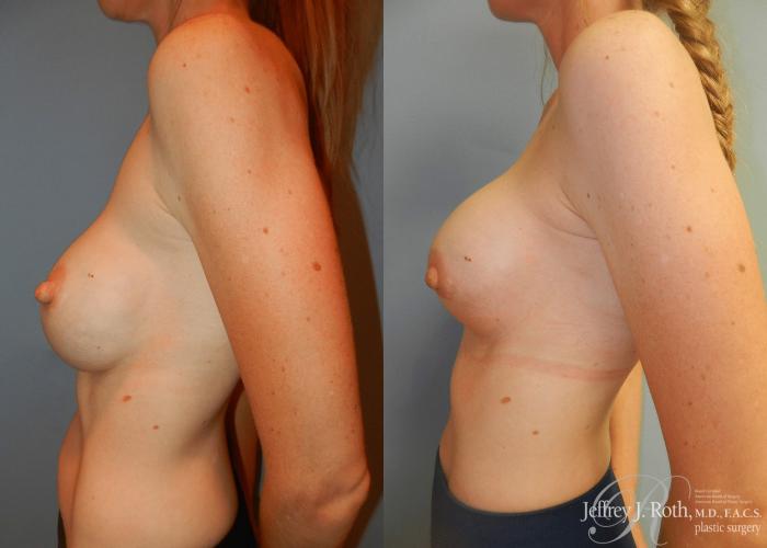 Before & After Breast Augmentation Revision Case 102 View #4 View in Las Vegas and Henderson, NV